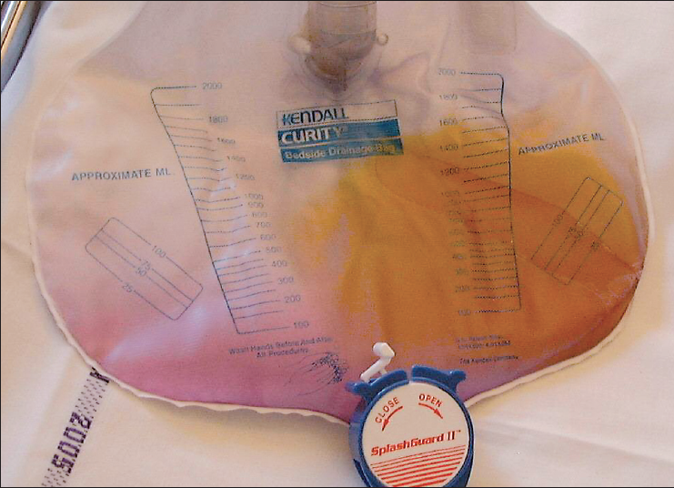 Something Bizarre in a Urine Collection Bag Consultant360